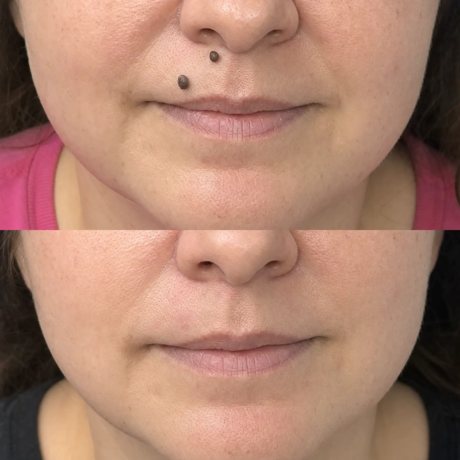 Before and after facial mole removal